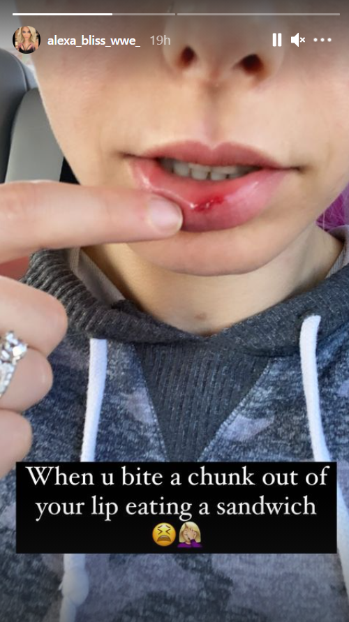 Alexa Bliss uploaded a video of her minor lip injury on Instagram. (Image Credits: @alexa_bliss_wwe on Instagram)